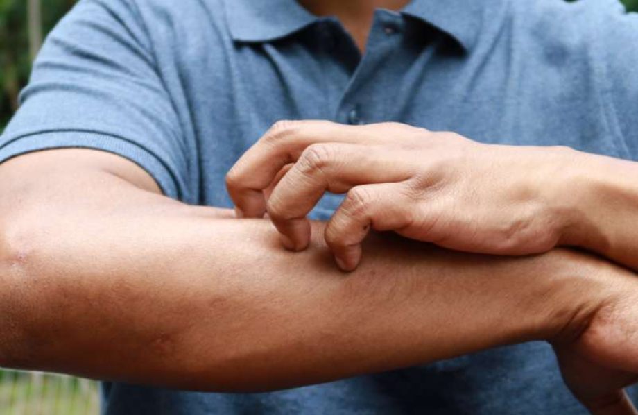 Zona : symptômes, causes et traitement